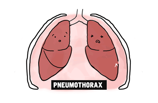 pneumothorax